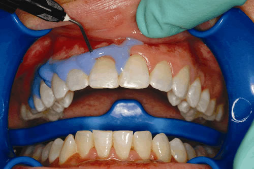 whitening lumibrite teeth retractor cheek paint dental shade dam chairside bleaching around tooth insert apply guide